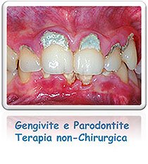 Gengivite e Parodontite: Terapia non-chirurgica