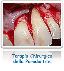 Terapia Chirurgica della Parodontite