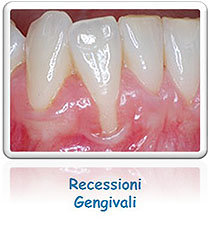 Recessioni gengivali