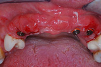 MUCOSITE
